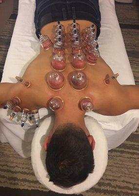 We offer Cupping, a very old Asian tradition to help aid with many types of ailments