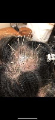 DrJiang does miracle hair regrowth with acupuncture treatment!