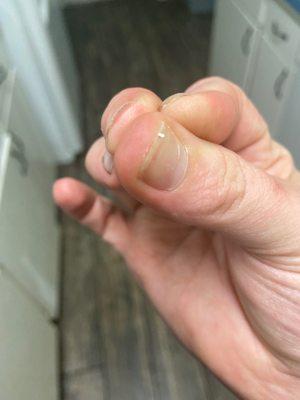 Fungal infection under nails