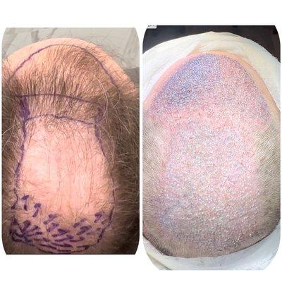 5700 Grafts hair transplant!