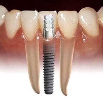 Tooth replacement with Implants Using IV Sedation