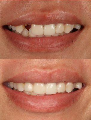 Real patient. Real result. Our patient gets her smile back same day and go back to work next day with dental implant.