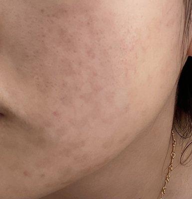 Hyperpigmentation after smoothbeam