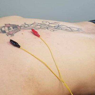 Dry needling