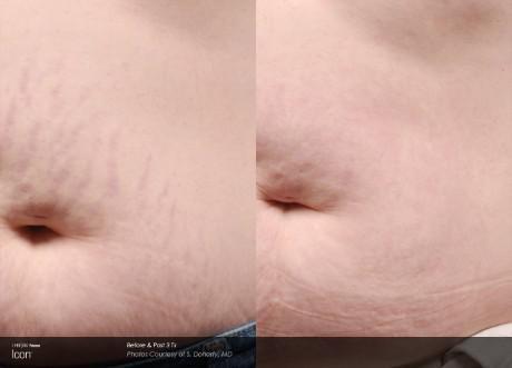 Stretchmark Removal