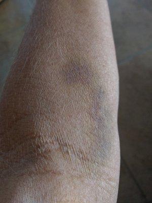 Pic taken one full week after an inept phlebotomist attempted to draw my blood at the Summit office of Sonora Quest Labs.