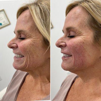 Dermal Filler for Laugh Lines around the mouth