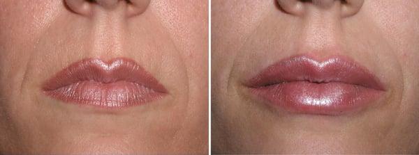 Before and after filler injection of lips