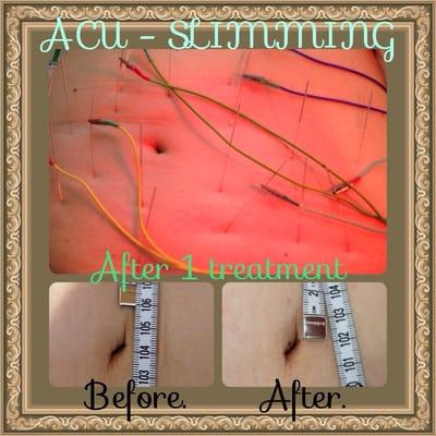 Acu - Slimming !