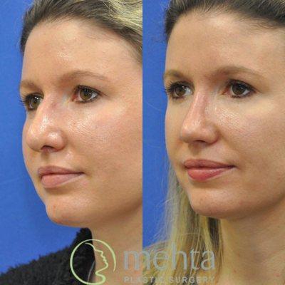 Rhinoplasty before (left) and after (right)