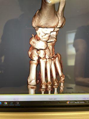 MRIshowing my Lisfrancs fracture dislocation with subluxation of the first, second and third tarsometatarsal joints creating abduction