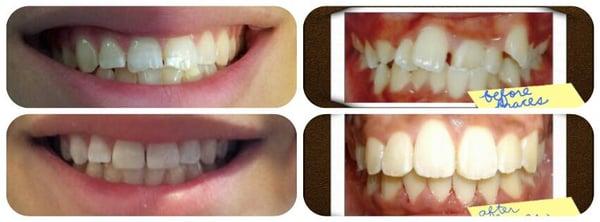 Left:  Before and After Composite Filling;  Right:  Before and After Ortho Treatment