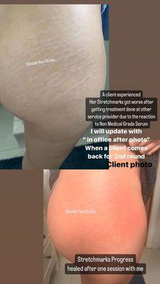 Stretchmarks removal