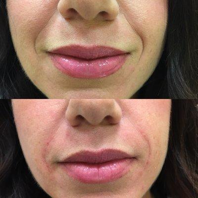 Juvederm to treat the "parentheses" around the mouth (nasolabial folds).