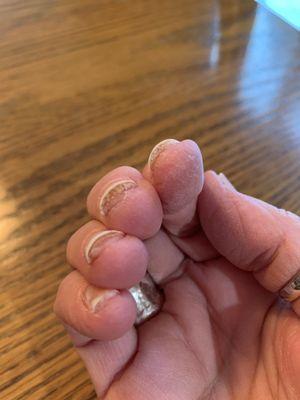 Nail fungus under nails. (All 10 fingers affected.)