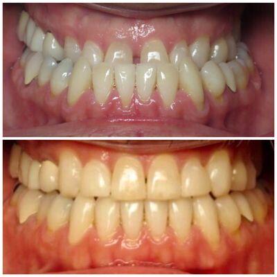 Can you believe this was achieved with Invisalign! NOW that's something to smile about! :)