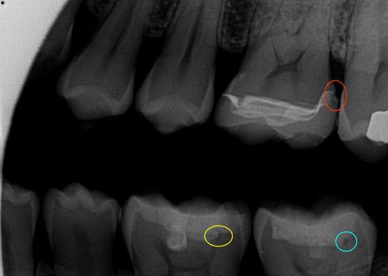 Crown ledge & failed fillings by Dr. Youssef.