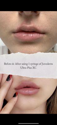 Lip enchantment done using 1 Syringe of Juvederm Ultra Plus XC.