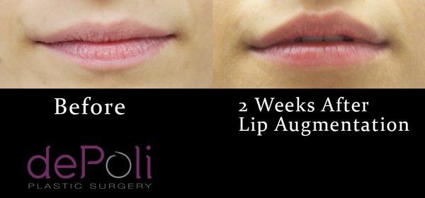 Lip augmentation