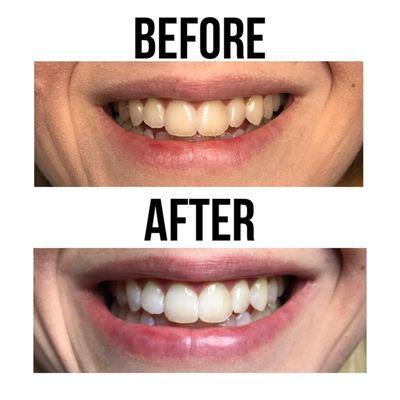 We offer BleachBright Teeth Whitening - guaranteed 2 to 8 shades brighter in a single session!