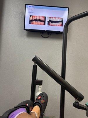 I'm the exam room watching a video of Zoom Teeth Whitening results (before & after pictures