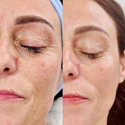 Skin tightening & lifting facial treatment