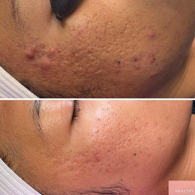 Before and after acne scarring client