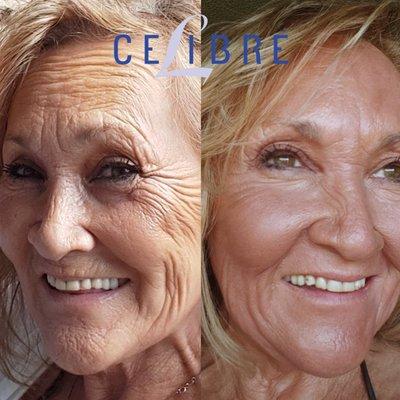 Laser Resurfacing for fine lines and wrinkles, one treatment!