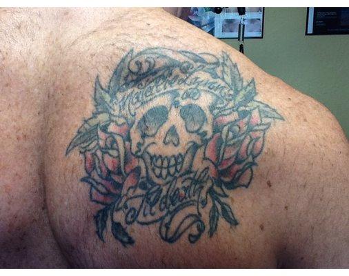 Tattoo before treatment with PicoWay laser.