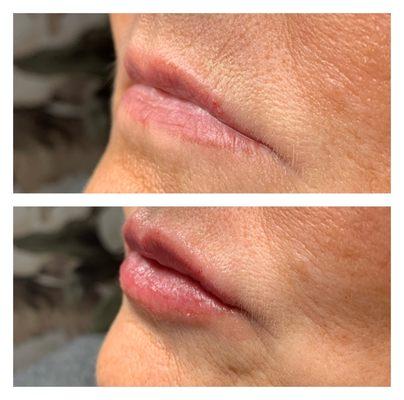 Lip enhancement