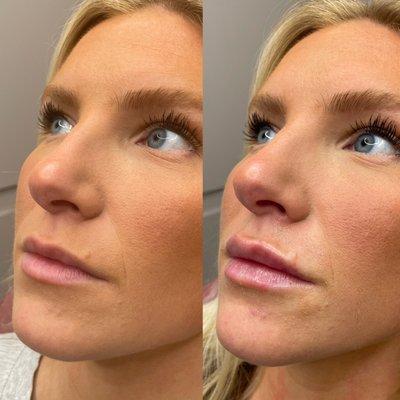 Before and After: Lip Filler