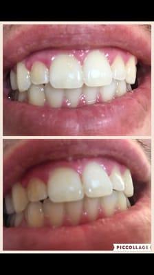 Bottom is my teeth before my first teeth whitening treatment and the top is after.