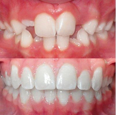 Who doesn't love a before and after? Team Orthodontics achieved this incredible transformation in 16 months with metal braces.