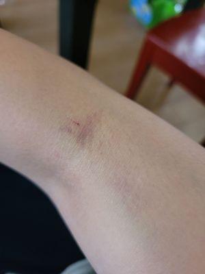 2 days later...big bruise :)