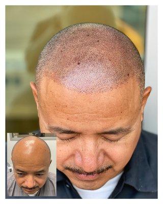 LIFE CHANGING RESULTS WITH SCALP MICROPIGMENTATION. CALL NOW FOR YOUR FREE CONSULTATION 844-4SCALPS