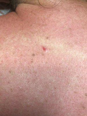 Skin cancer discovery during a back treatment