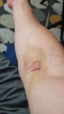 Four days after blood draw. 3.5 inch bruise.