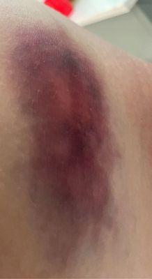 Extreme bruising on hip bone