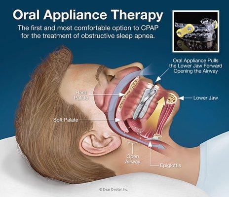 How the oral appliance works!