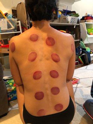 Cupping done by the amazing Kai!