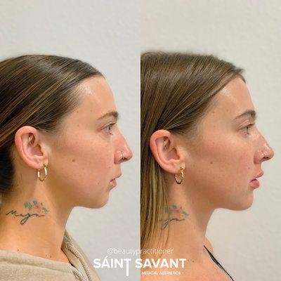 LOWER FACE BALANCING (chin + lips) using dermal fillers