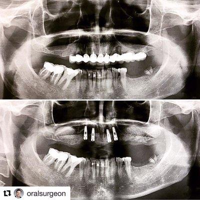 Full upper arch extractions with bilateral sinus lifts and 4 anterior implants