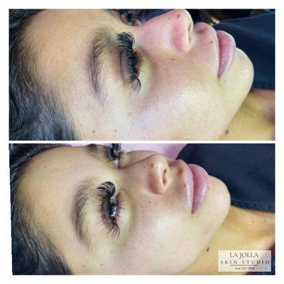 Gorgeous glow after first treatment with LJSS