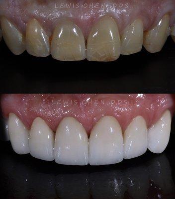 Veneers