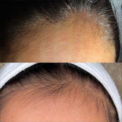 Hair restoration