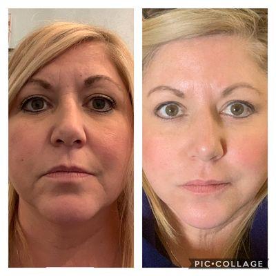 Transformation completed with cheek filler, lip filler, neurotoxin (Jeuveau)microneedling and skincare.