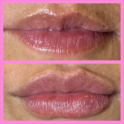 Lip filler to give volume and hydration to. Lips