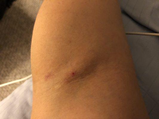 My messed up arm :(  Previous scar tissue was not visible and could only be felt when you pushed on the vein.