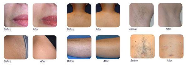 Laser Hair Removal Before & After Pictures.