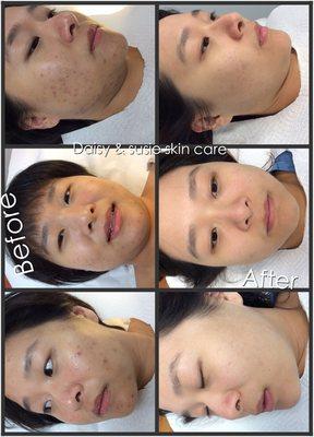 Acne and scar removal